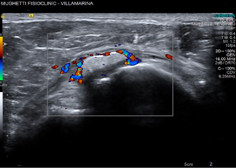 ecografia alla spalla con color doppler