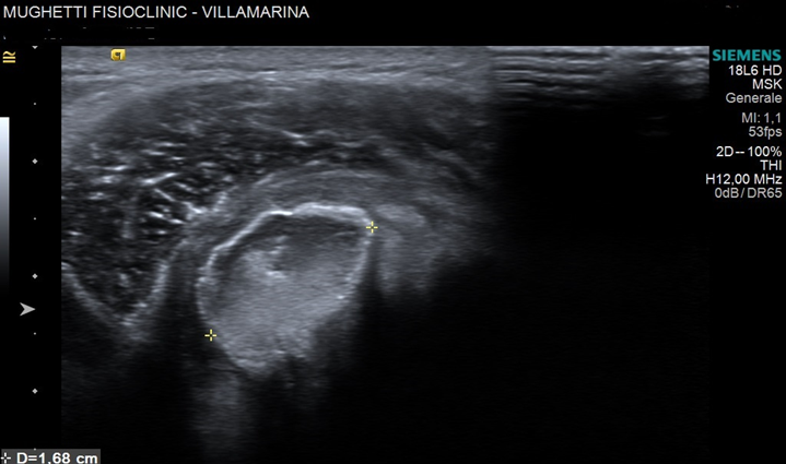 calcificazione di spalla